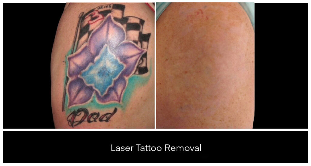 Laser Tattoo Removal London Ontario Yazdani Aesthetics