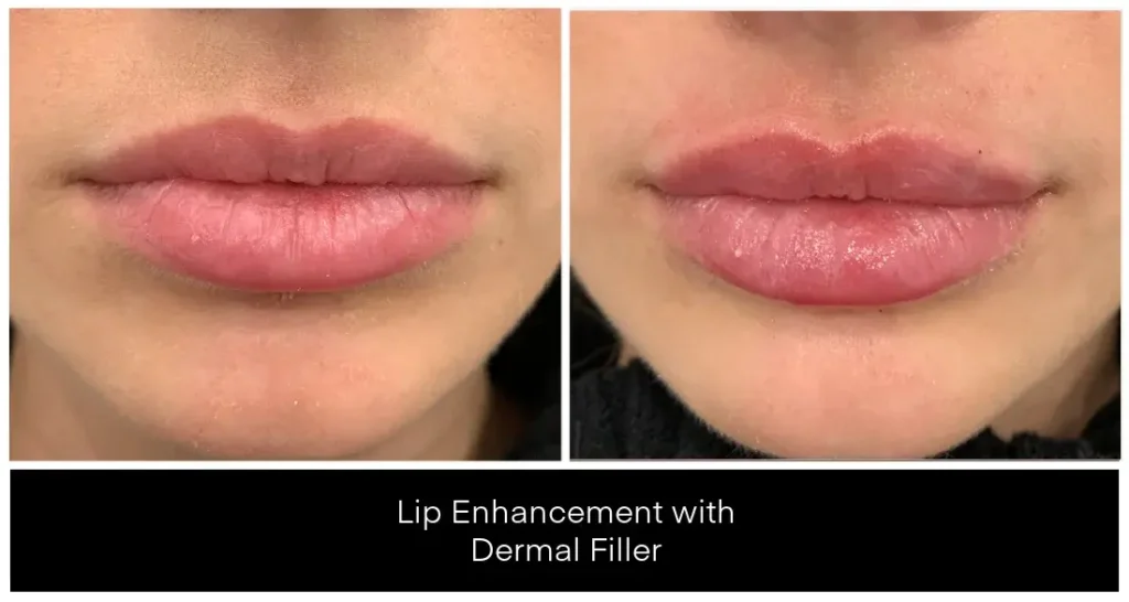 Before and after a lip filler treatment.